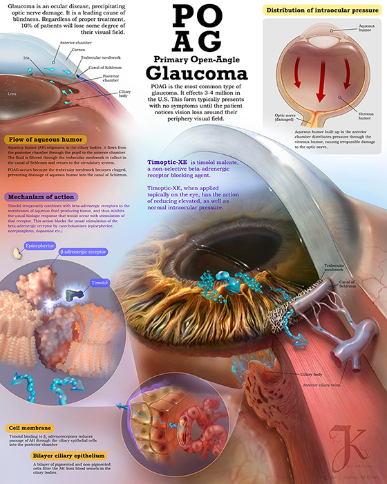 Medical Illustration of Glaucoma poster